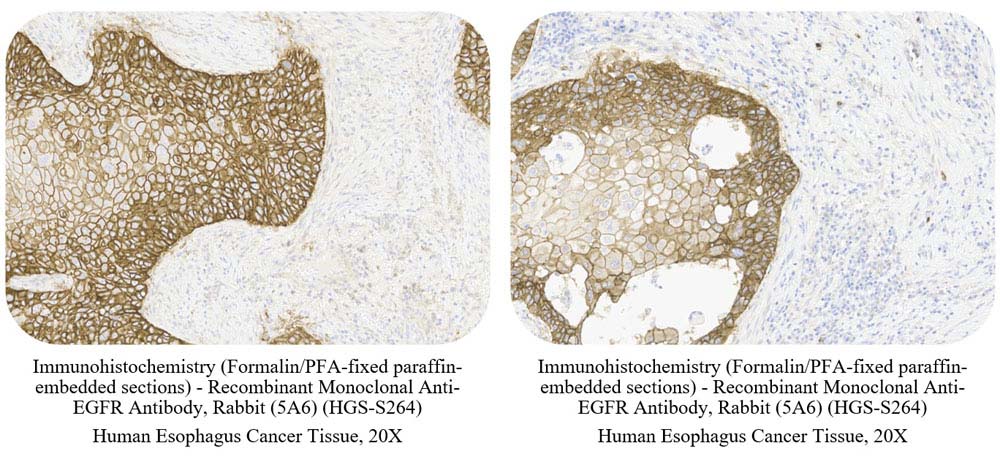  EGF R CANCER SAMPLE