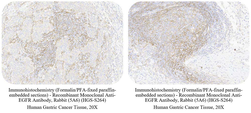  EGF R CANCER SAMPLE
