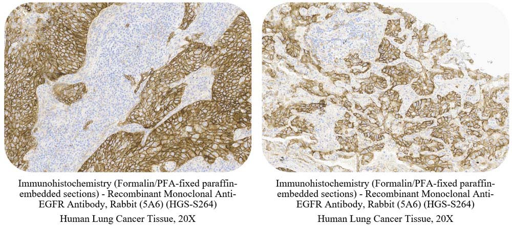  EGF R CANCER SAMPLE
