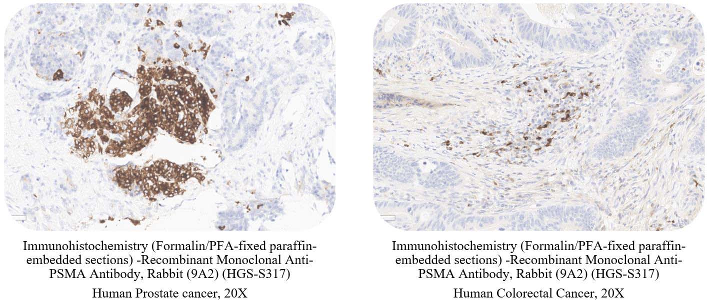  PSMA CANCER SAMPLE